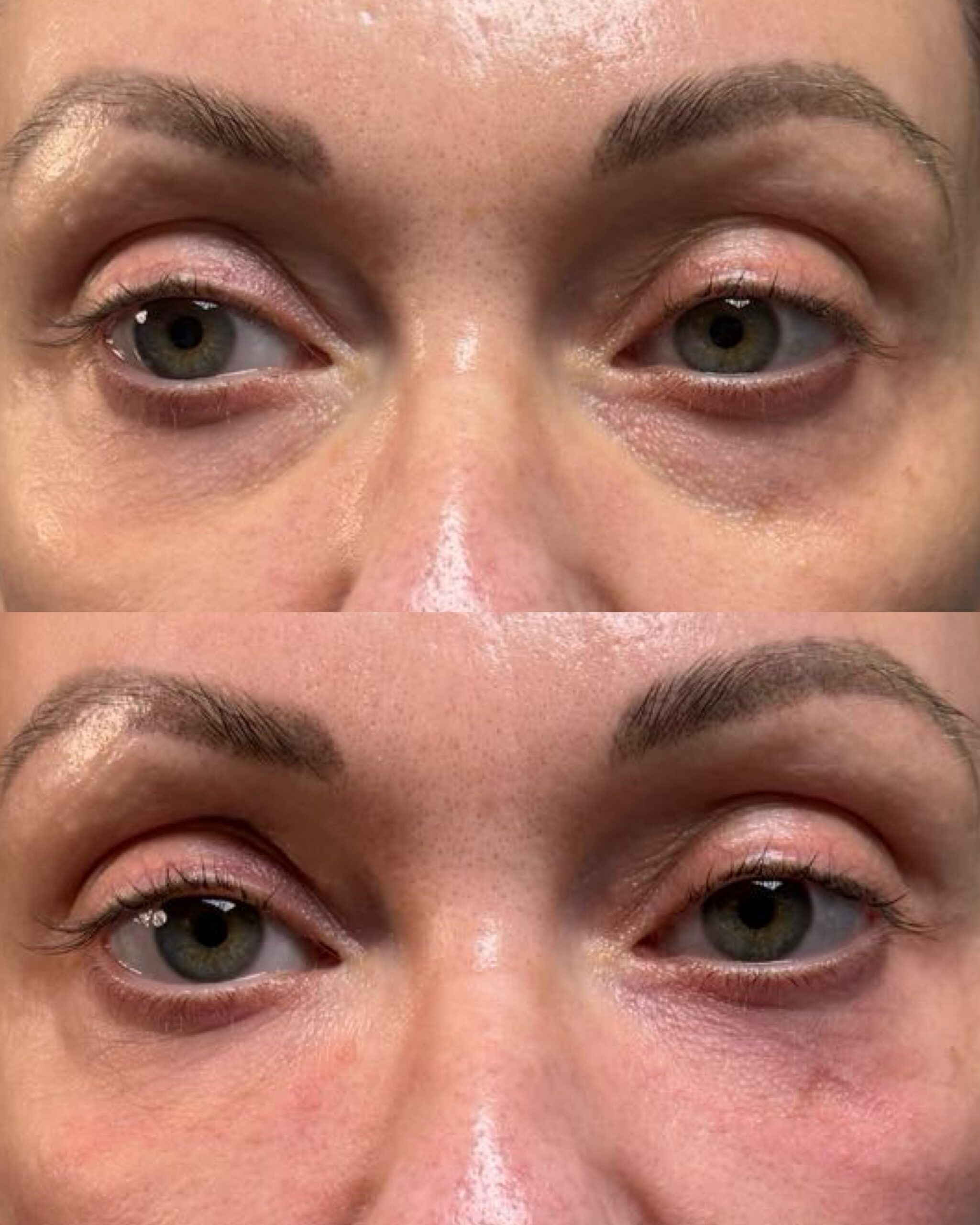 PRF before after 2