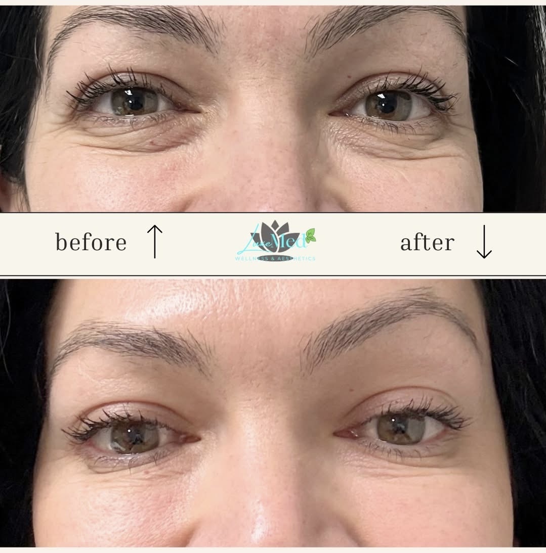 PRF treatment